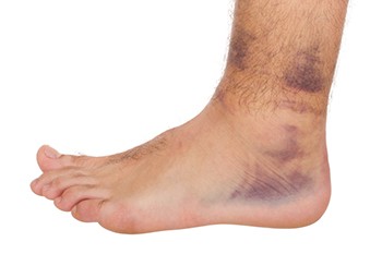 Three Types of Ankle Sprains